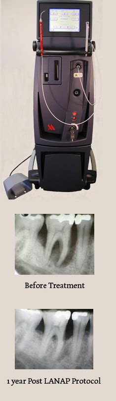 Laser dentistry for Gum Disease Treatment (Periodontitis & Gingivitis)