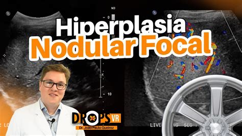 Como Reconhecer Hiperplasia Nodular Focal I Voc Radiologista Youtube