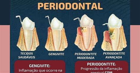 HM Odontologia em Ribeirão Pires Doença Periodontal Gengivite x