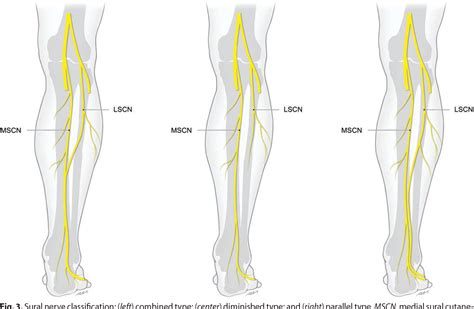 Anatomy Of Sural Nerve