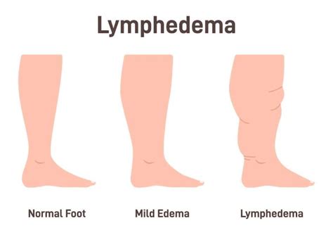 Lymphedema Symptoms: 11 Early Warning Signs and Symptoms Of Lymphedema ...