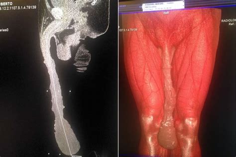 El Drama Del Hombre Con El Pene Más Largo Del Mundo Guinness No