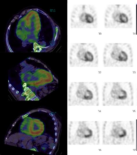 Cardiac Amyloidosis Patient With Cardiac Conduction Disturbances