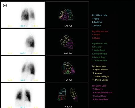 Lung Segments Vq