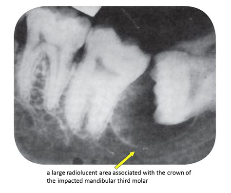 Dentosphere : World of Dentistry: Dentigerous Cyst / Follicular Cyst