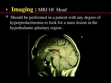 Prolactinoma