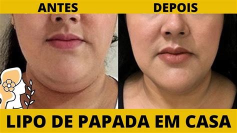 VOCÊ PODE FAZER LIPO DE PAPADA em CASA RESULTADO IMEDIATO YouTube