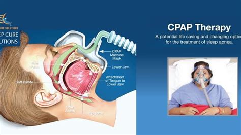 CPAP Therapy And Treatment Sleep Cure Solutions