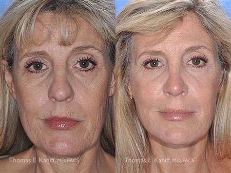 Mini Face Lift Facial Cosmetic Surgery Associates Facial Cosmetic