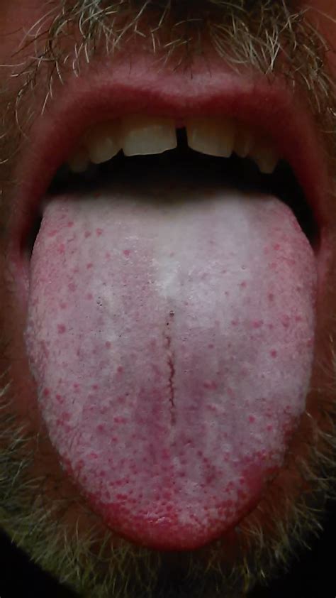 Ahhh Picture Of My Tongue Covered In Hydrogen Peroxide Flickr