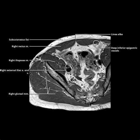 Jejunal Ileal Atresia Radiology Key