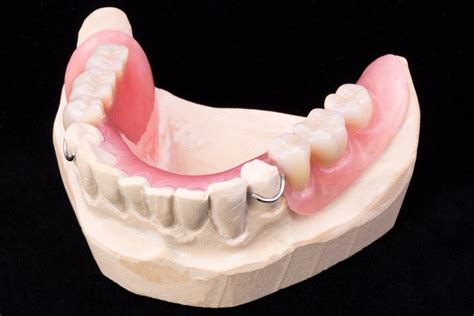 Acrylic Partial Denture South Calgary Denture And Implant Clinic