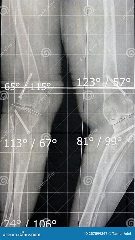 Bilateral Metaphyseal Genu Varum Previous Epiphysiodesis Left Distal