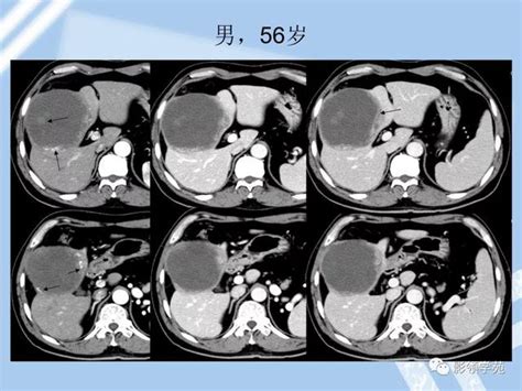 22種肝臟少見及不典型腫瘤的影像表現 每日頭條