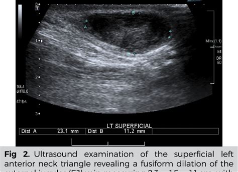figure   external jugular vein thrombosis secondary  deep tissue