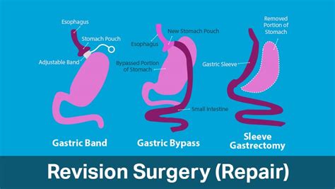 Revision bariatric surgery - Revision weight loss surgery