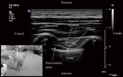 Ultrasound Guided Thoracic Paravertebral Block Nysora