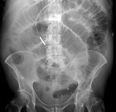 Ibd Infectious Diarrhea Upper And Lower Radiology Neoplasia Of The