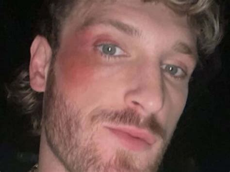 Logan Paul Shows Off Scar Under His Eye After Getting Knocked Out Cold