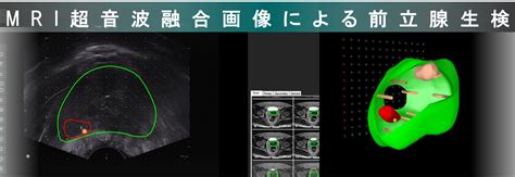 Mri超音波融合画像による前立腺生検｜徳島赤十字病院