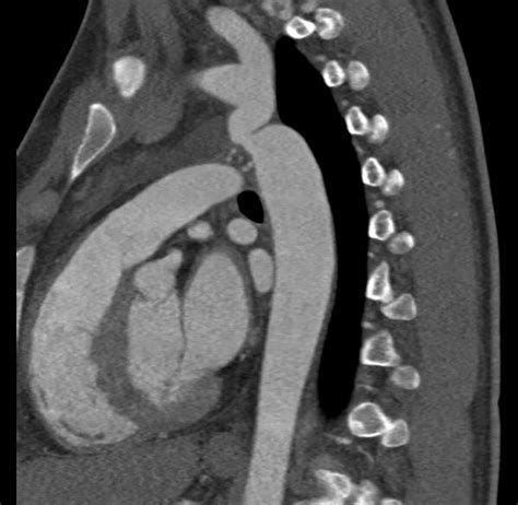 Ct Angiography Of Aorta Showing Coarctation Distal To The Left Download Scientific Diagram