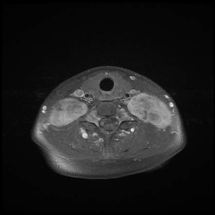 Plexiform Neurofibromas Neurofibromatosis Type Image