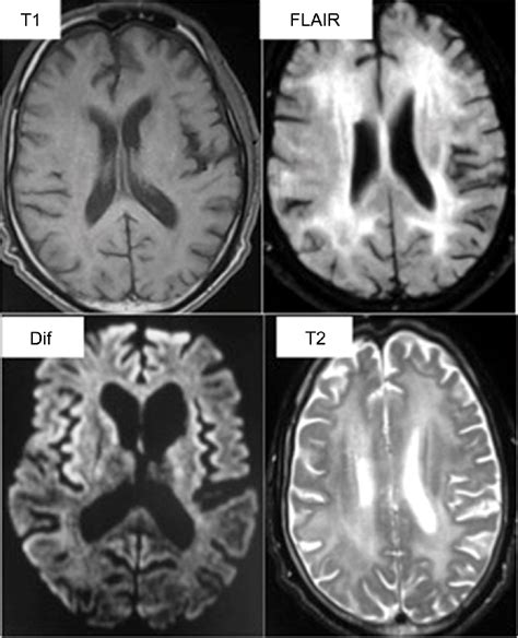 Hiv Encephalitis Diffuse Range Of Flair Hypersignal And T2 Of Download High Quality