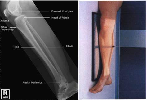 Lateral Tib Fib Study Terms Definitions Medicine Flashcards Quizlet