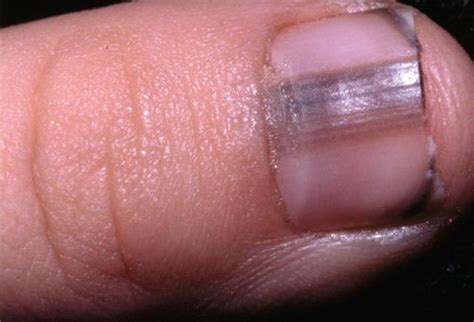 What causes fingernail problems? – What causes this?