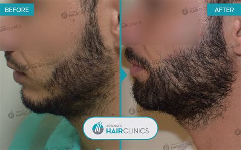 FUE Beard Transplant | Advanced Hair Clinics