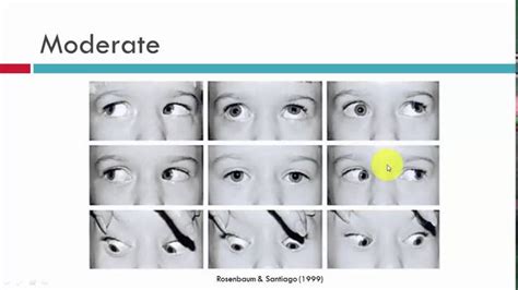 Brown S Syndrome Classification Classification Syndrome D Day