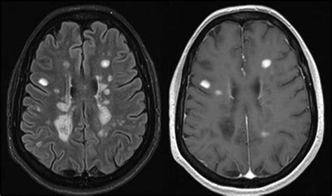 Magnetic Resonance Monitoring Of Lesion Evolution In Multiple Sclerosis