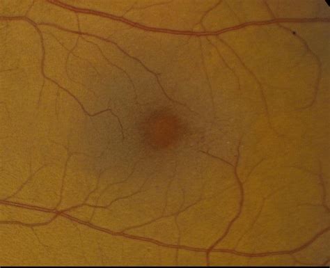 A And B Color Fundus Photographs Demonstrating The Subtle Loss Of