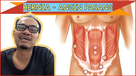 Hernia Angin Pasang Dan Hubungannya Dengan Kanser Prostat Bambale