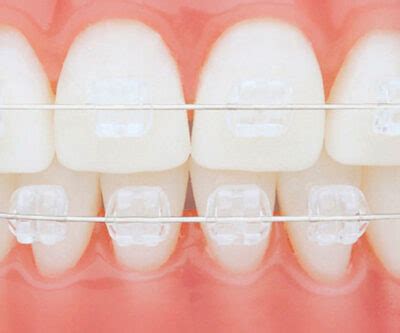 Aparelho Ortodôntico Prórir Dentistas Especializados