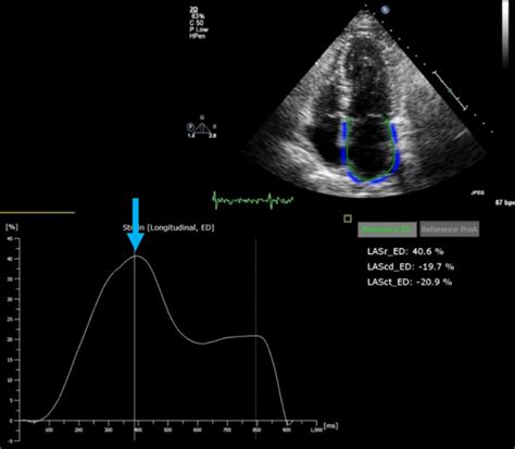 Left Atrial Strain By Speckle Tracking Echocardiography Upper Panel