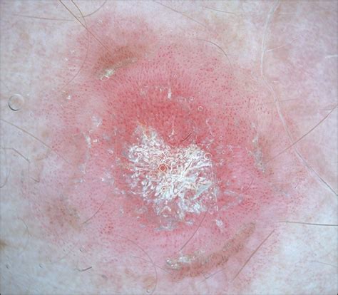 Dermoscopy Subpatterns Of Inflammatory Skin Disorders Dermatology