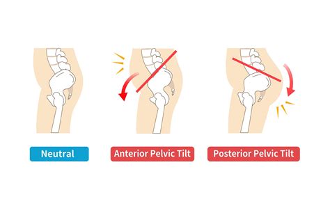 fix anterior pelvic tilt  chronic   pain