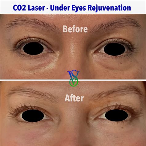 Under Eyes Bags Dark Circles CO2 Laser Correction In Glendale CA