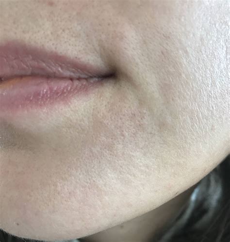 [Skin Concerns] Patch of bumpy, rough skin in chin : r/SkincareAddiction