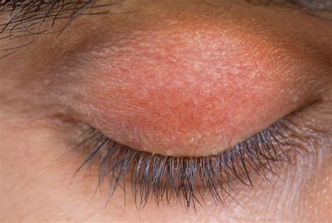 Red Rash On Eyelids