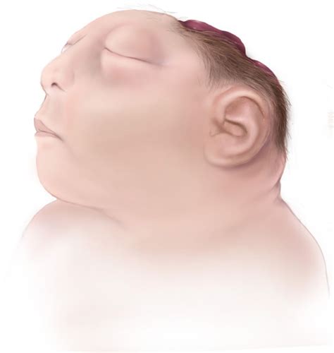 Anencephalic Newborn As An Organ Donor An Ethical And Medical Dilemma