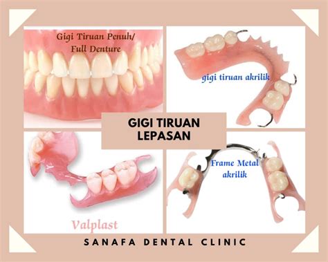 Mengenali Jenis Jenis Gigi Palsu Lepasan