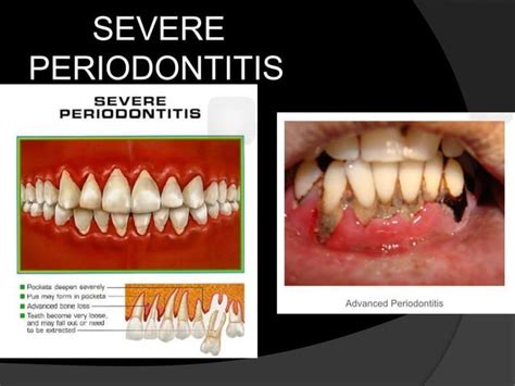 Chronic Periodontitis Ppt