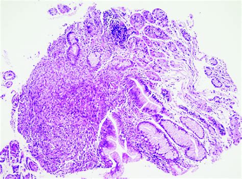 Histopatología de sarcoma de Kaposi gástrico Download Scientific Diagram