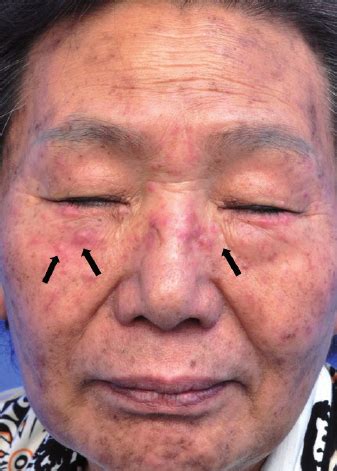 Several Match Head Sized Erythematous Papules And Nodules Along The