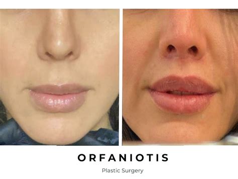 Remove Scars On Lips Lipstutorial Org