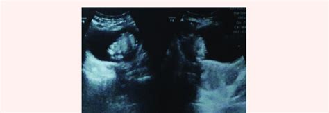 Pelvic Trans Abdominal Ultrasound Image Showing Echogenic Mass In The Download Scientific