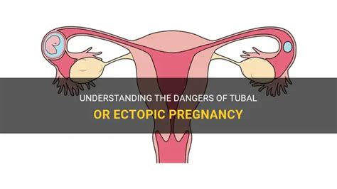 understanding  dangers  tubal  ectopic pregnancy shunchild