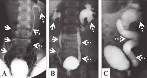 International Grading Of Vesicoureteral Reflux Grading By Voiding